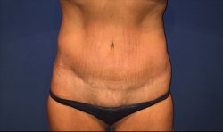 Manhattan abdominoplasty after 16